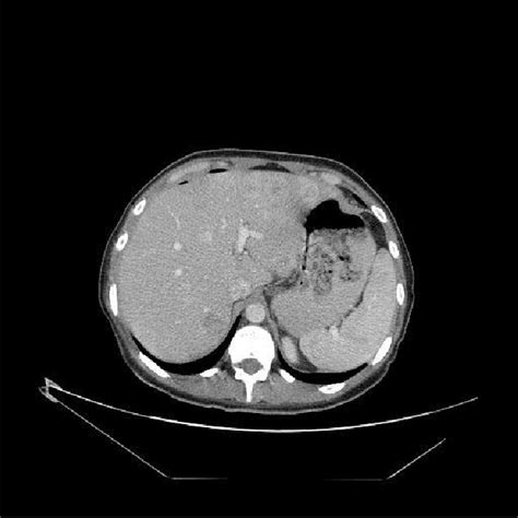 CT scan revealed multiple liver metastases | Download Scientific Diagram