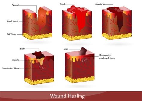 Wound & Ulcer Types | DFW Wound Care Center