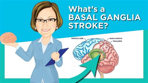 Basal Ganglia Stroke - YouTube