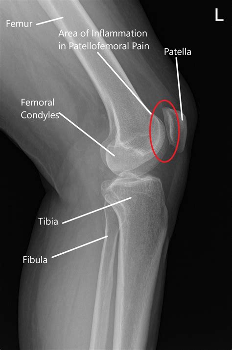 Patellofemoral Syndrome X Ray