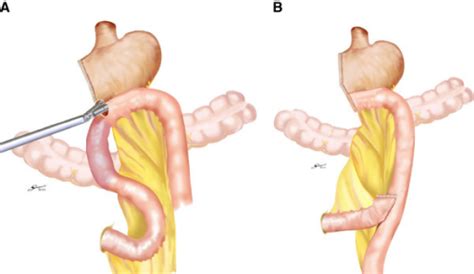 Intracorporeal Roux-en-Y anastomosis. (A) A side-to-sid | Open-i