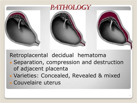 Abruptio placenta- Define, cause, sign and symptoms, Risk Factors, Incidence,pathology ...