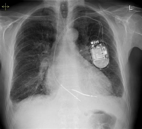 Kerley B Lines Cxr : Septal lines in lung | Radiology Reference Article ... : They are thin ...