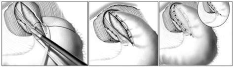 Dor Fundoplication