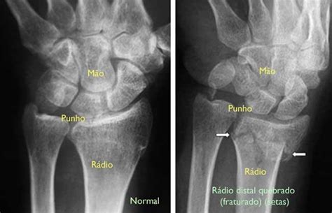 Fraturas distais do rádio (fratura do punho) (Distal Radius Fractures (Broken Wrist ...