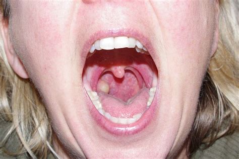 Cancerous tonsil cyst | Meshotelioma Cancer | Pinterest