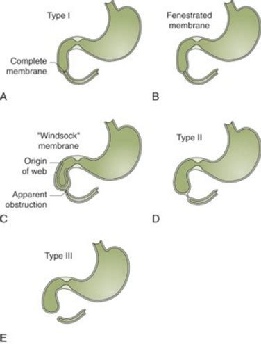 Duodenal atresia