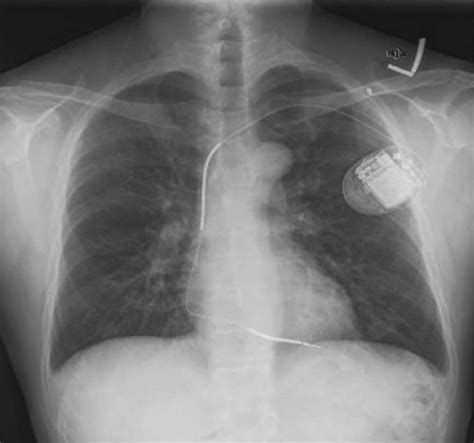 Permanent Pacemaker Implantation