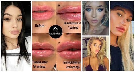 LIP Fillers & Why Is Everyone Getting Them?! - The Fashion Tag Blog