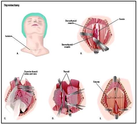 Thyroidectomy Basics | Epomedicine