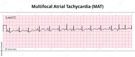 Vetor de Multifocal Atrial Tachycardia (MAT) - 8 Second ECG Paper ...