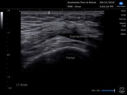 Ultrasound Suprapatellar recess above knee cap