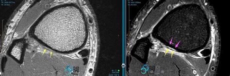 PERIOSTEAL REACTION RADIOLOGY MRI: THE RANGE OF TRAUMATIC PERIOSTEAL ...