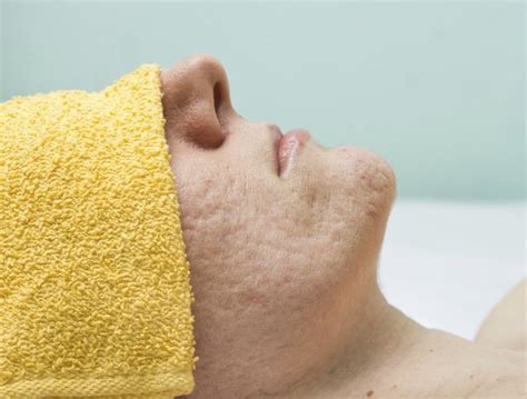 How to Get Rid of Cystic Acne Scars | Livestrong.com