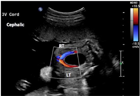 Umbilical Artery Ultrasound