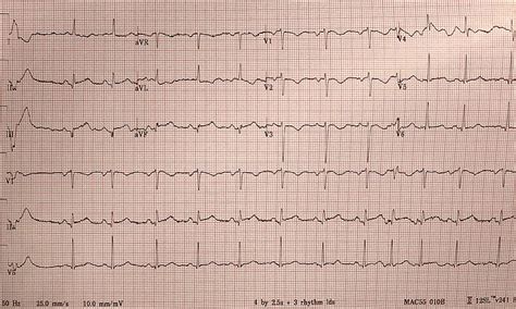 Girl Who Cried Wolf: A Case of Prinzmetal Angina With Related ST-Elevation Myocardial Infarction ...