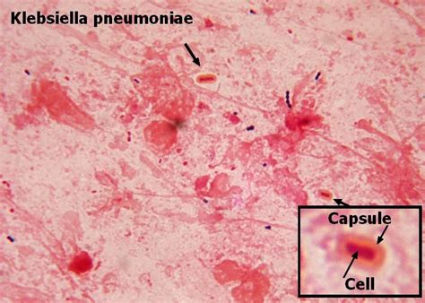 Fun With Microbiology (What's Buggin' You?): Klebsiella pneumoniae Capsule