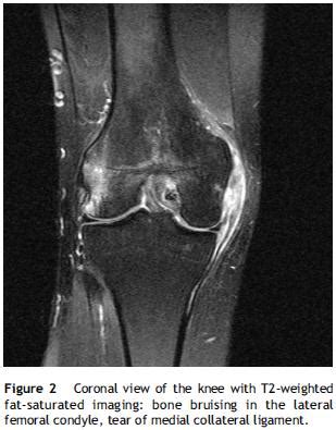 Bone bruise - Physiopedia