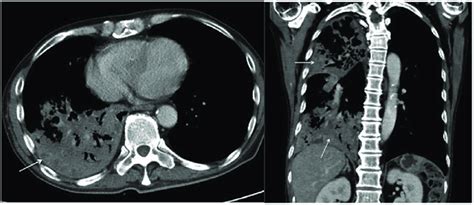 Primary pulmonary tuberculosis pattern with lobar consolidation. A ...