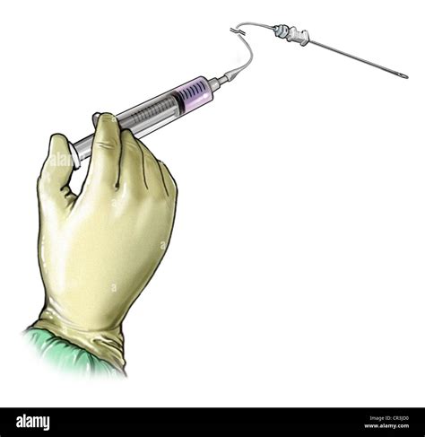 Marcaine Injection - Femoral Nerve Block Stock Photo - Alamy