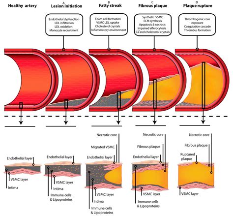 Pathophysiology of Atherosclerosis – Pathology