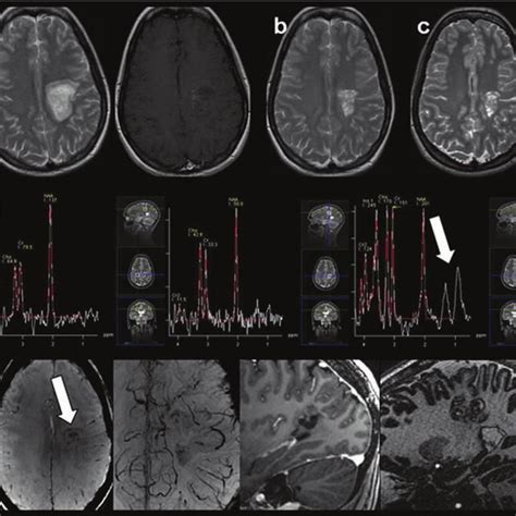 (a) 1.5 T MRI (April 2009): T2-weighted image (first image) showed an ...