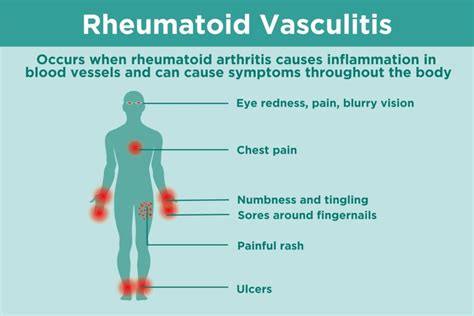 What Is Rheumatoid Vasculitis? Symptoms, Diagnosis, and Treatment