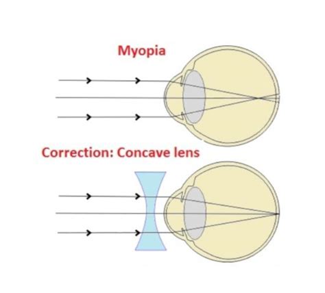 what is myopia? state two causes of myopia help of labelled diagram show [a] the eye defect ...