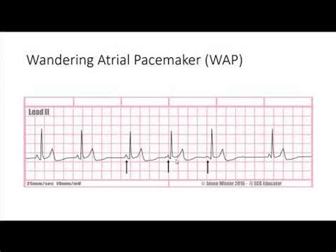 wandering atrial pacemaker ecg - Captions Editor