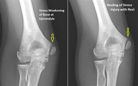 OrthoKids - Throwing Injuries