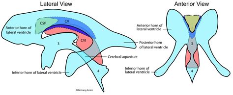 Cavum Velum Interpositum on MRI