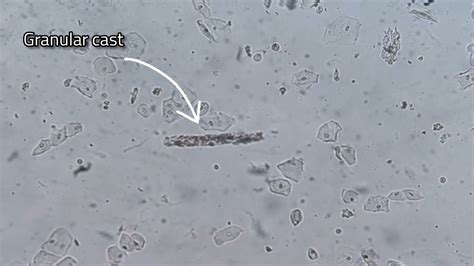 Urine analysis (granular cast & transitional epithelial cells) - YouTube