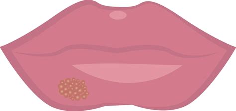 Lips With Visible Cold Sores On The Mouth Vector, Illness, Mouth, Virus PNG and Vector with ...