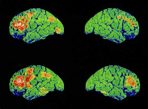 Pet Brain Scans Of Schizophrenic Speaking Photograph by Wellcome Dept. Of Cognitive Neurology ...