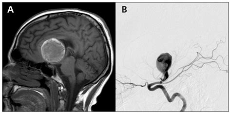 Cerebral Aneurysm Mri