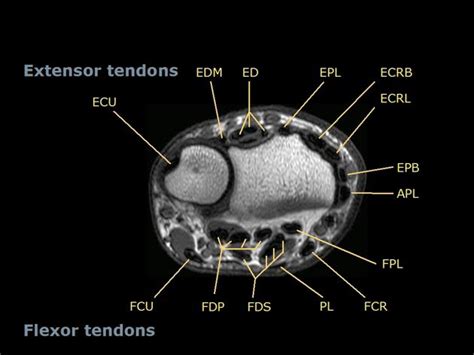 Left Wrist Mri Anatomy