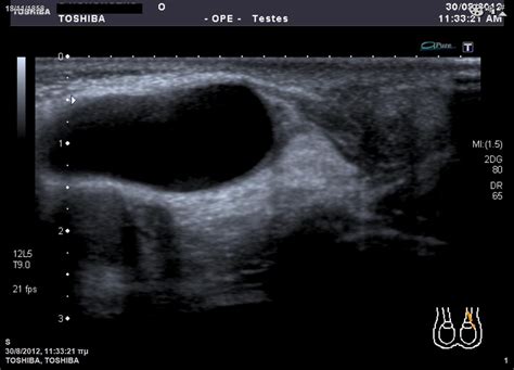 Spermatic Cord Hydrocele-USG - Sumer's Radiology Blog