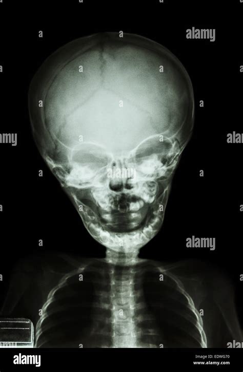 Infant skull hi-res stock photography and images - Alamy