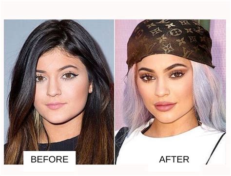 Kendall And Kylie Jenner Plastic Surgery – Telegraph