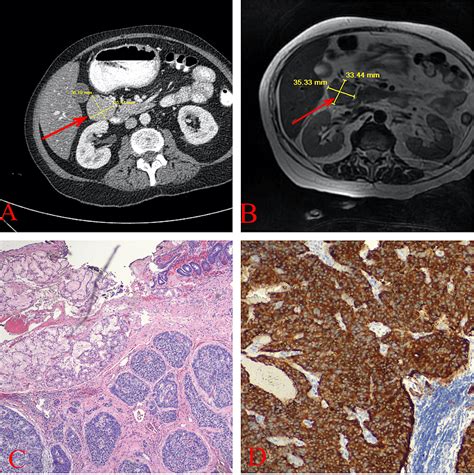 Cureus | A Rare Presentation of a Duodenal Neuroendocrine Tumor