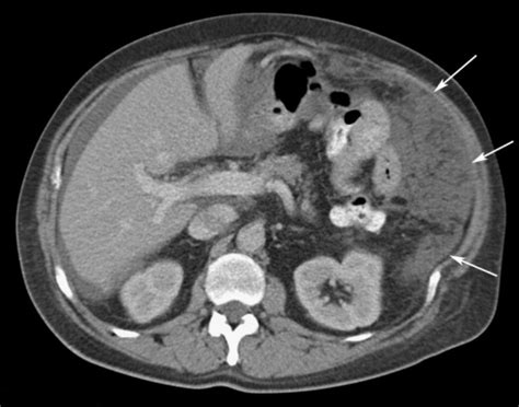 Colon cancer in a 65-year-old man. CT image demonstrate | Open-i