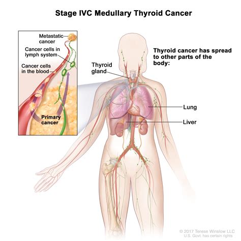 Thyroid Cancer | UCSF Department of Surgery