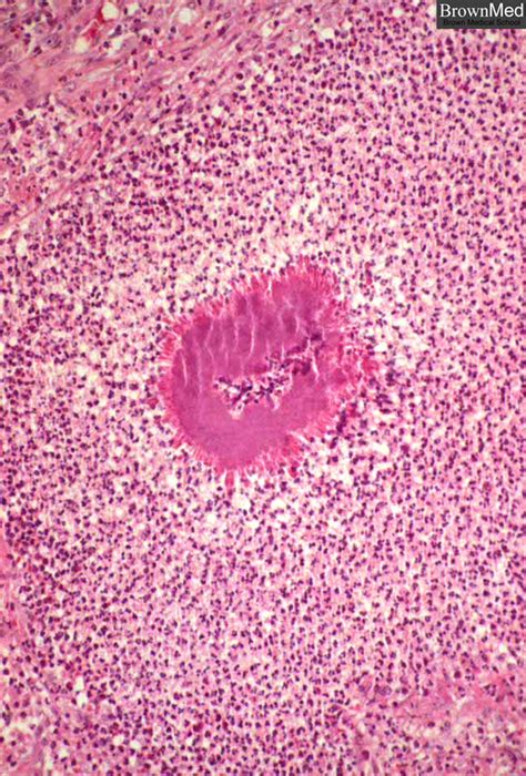 Actinomycosis; Actinomyces Infections