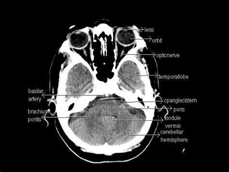 CT Anatomy