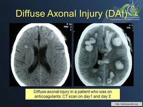 Diffuse axonal injury (DAI) also known as traumatic axonal injury (TAI) - multiple focal lesions ...