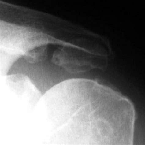 Os acromiale and shoulder pain | Eurorad