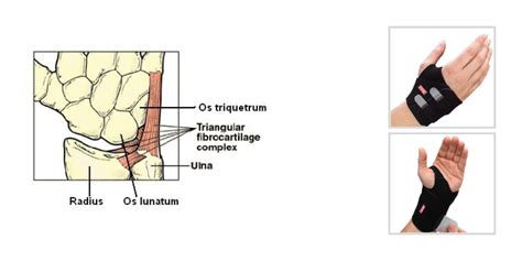 TFCC Ulnar Sided Wrist Pain Anatomy, Diagnosis Treatment, 42% OFF