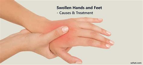 Swollen Hands And Feet - Causes & Treatment