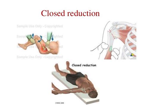 Fracture