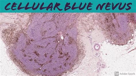 Blue Nevus Histology